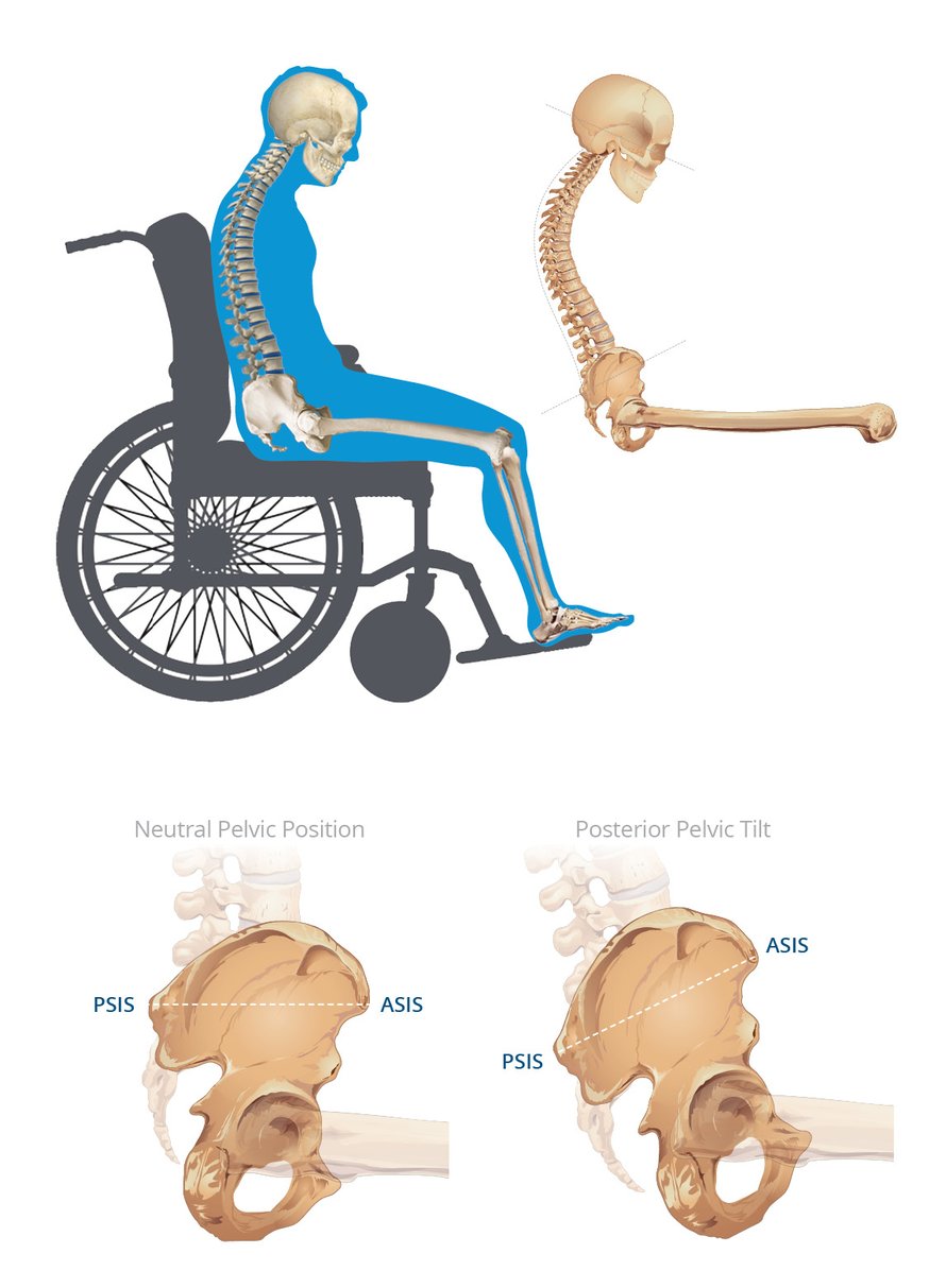 Posterior Pelvic Tilt The Correction of Sacral Sitting
